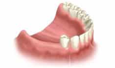 Multiple Tooth Replacement Full Arch Replacement Dental Care of Jackson Hole Dr. Schmidt Dr. Jorgensen Jackson, Wy