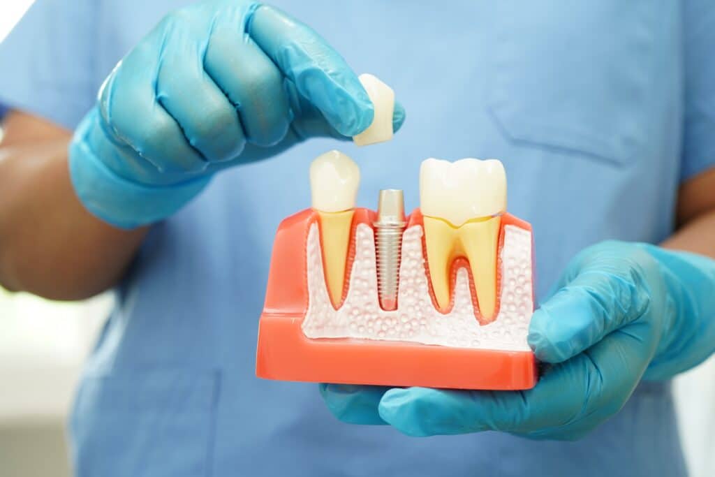 dental implants near me